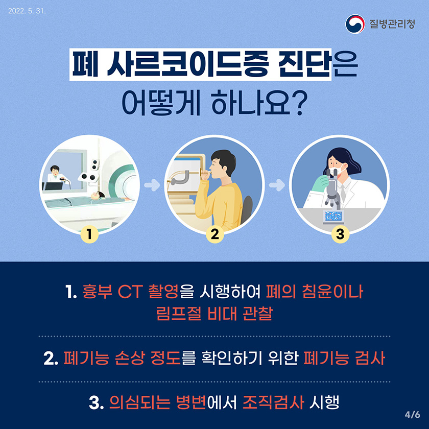 폐 사르코이드증 진단은 어떻게 하나요? 1.흉부 CT 촬영을 시행하여 폐의 침윤이나 림프절 비대 관찰, 2.폐기능 손상 정도를 확인하기 위한 폐기능 검사, 3.의심되는 병변에서 조직검사 시행 4/6